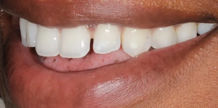 Before composite bonding treatment at Hacton Dental Care, Hornchurch