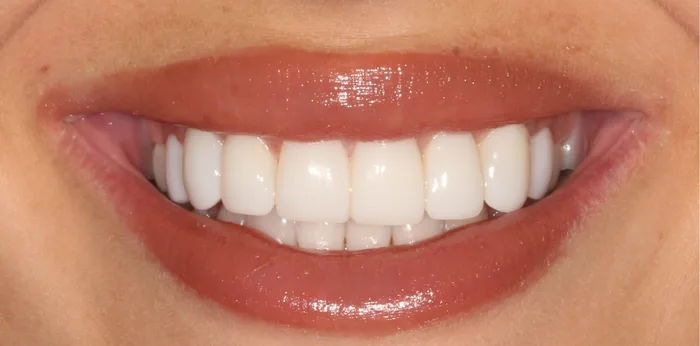 After composite bonding treatment at Hacton Dental Care, Hornchurch