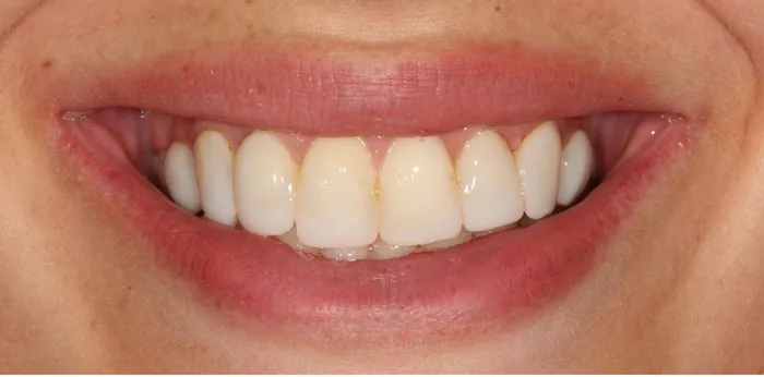 Before composite bonding treatment at Hacton Dental Care, Hornchurch