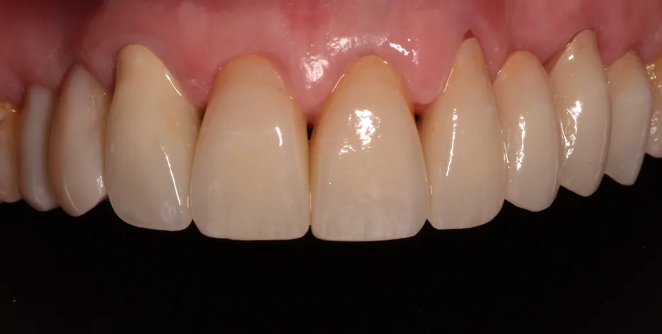 After single tooth implant with custom crown