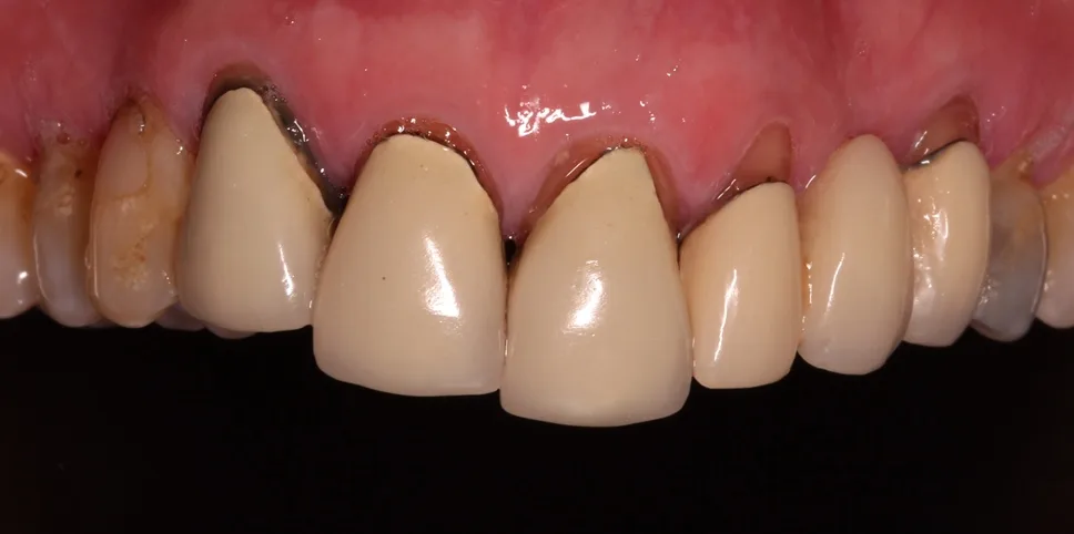 Before single tooth implant