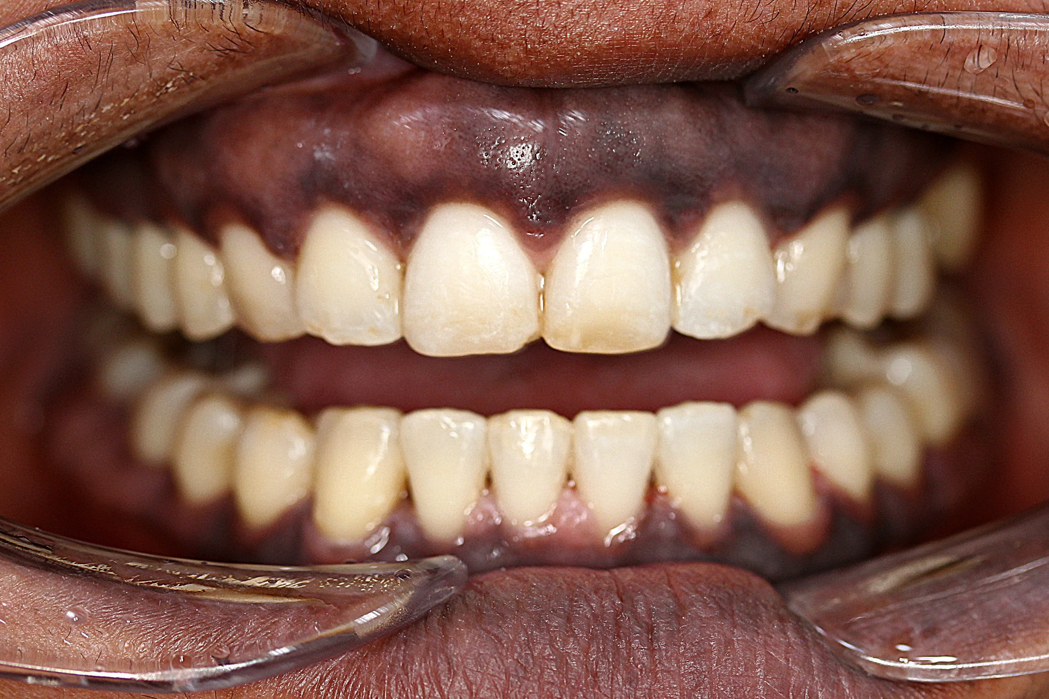 After fixed brace treatment