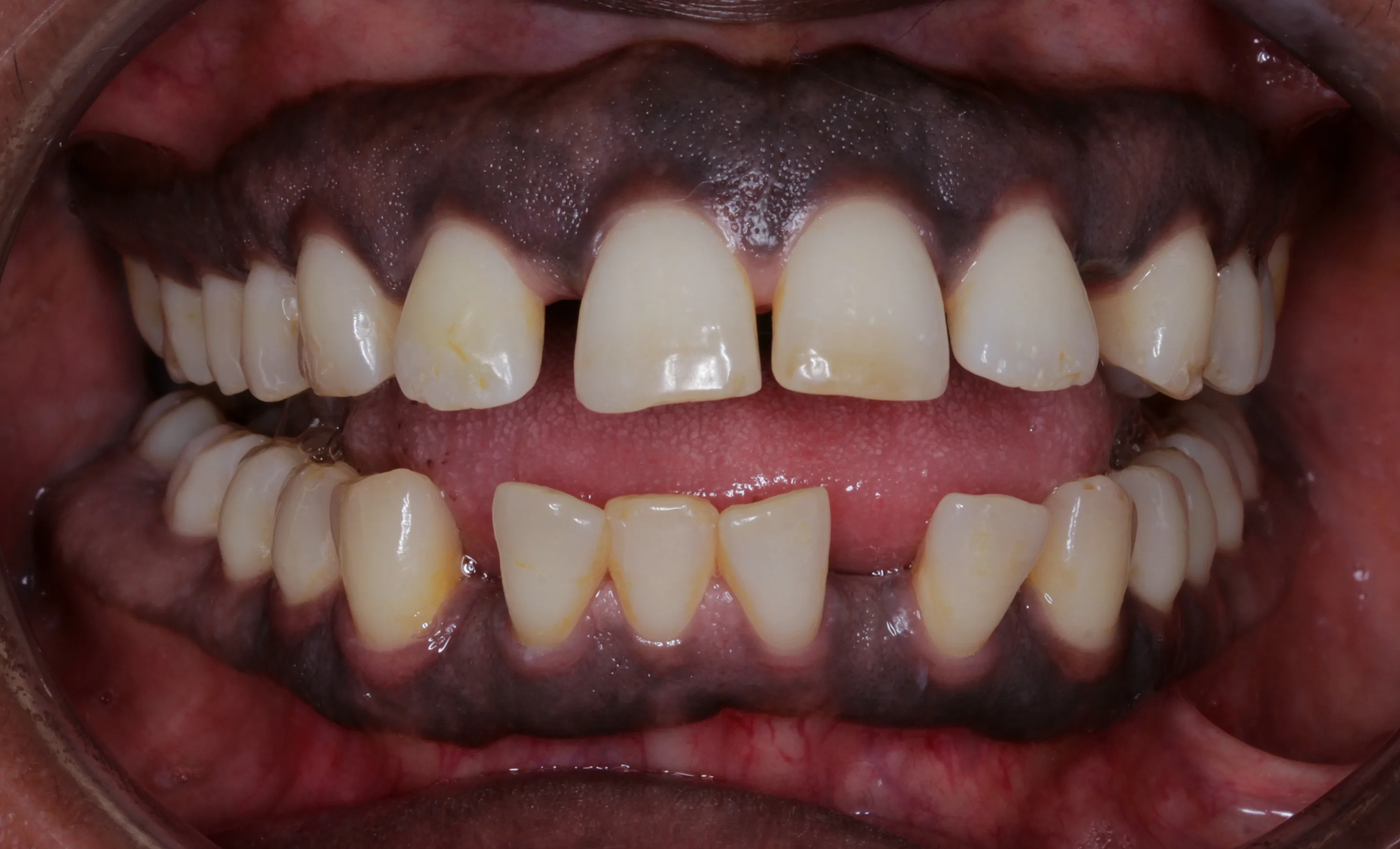 Before fixed brace treatment