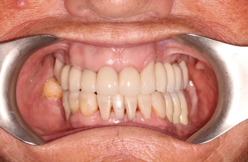 After implant retained denture treatment