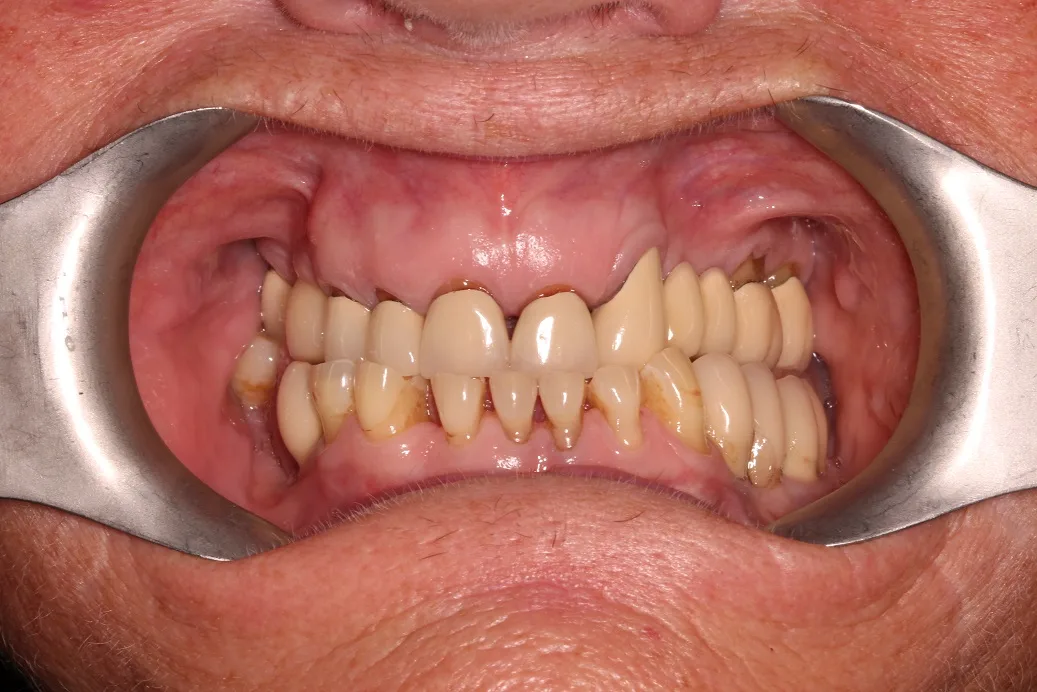 Before implant retained denture treatment