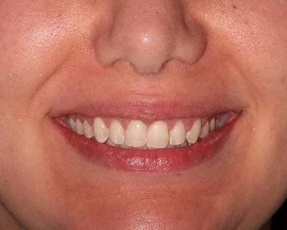 After crown lengthening and gum surgery treatment at Hacton Dental Care, Hornchurch