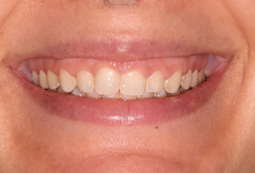 Before crown lengthening and gum surgery treatment at Hacton Dental Care, Hornchurch