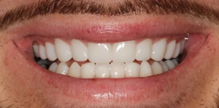 After invisalign treatment at Hacton Dental Care, Hornchurch