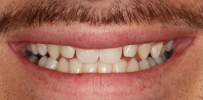 Before invisalign treatment at Hacton Dental Care, Hornchurch