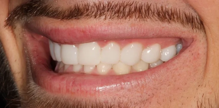 After invisalign treatment at Hacton Dental Care, Hornchurch