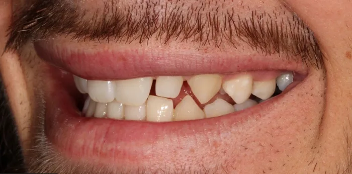 Before invisalign treatment at Hacton Dental Care, Hornchurch