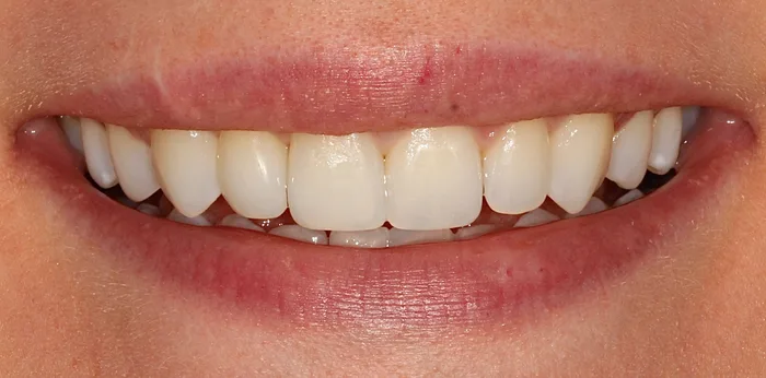 After invisalign treatment at Hacton Dental Care, Hornchurch
