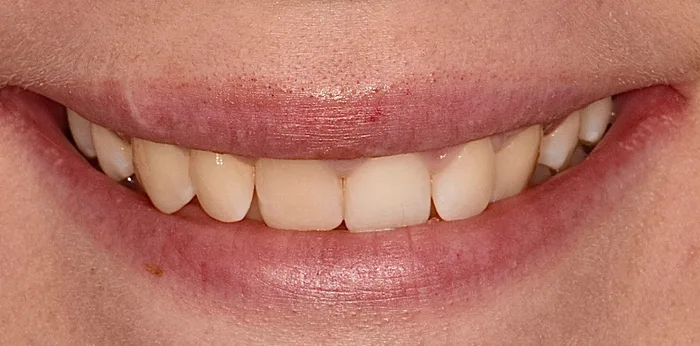 Before invisalign treatment at Hacton Dental Care, Hornchurch