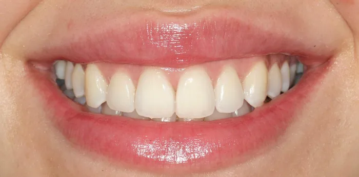 After invisalign treatment at Hacton Dental Care, Hornchurch