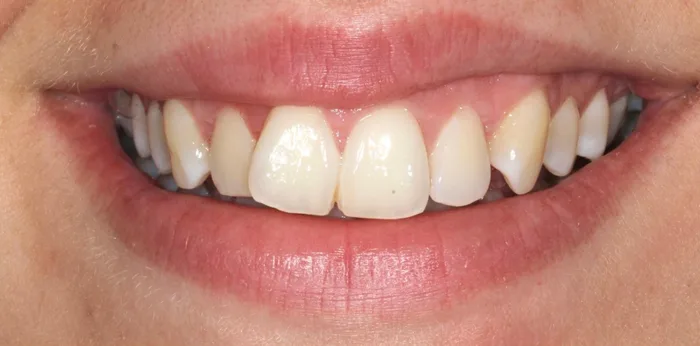 Before invisalign treatment at Hacton Dental Care, Hornchurch