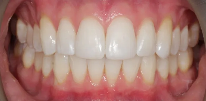 After invisalign treatment at Hacton Dental Care, Hornchurch