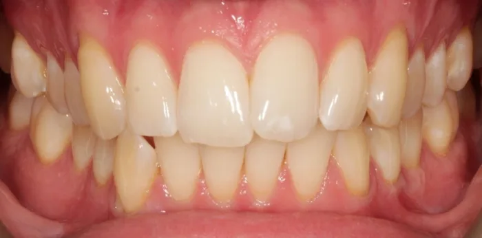 Before invisalign treatment at Hacton Dental Care, Hornchurch