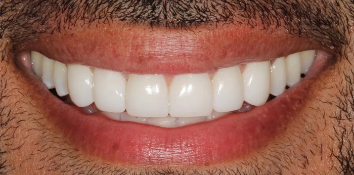 After smile makeover with composite bonding treatment at Hacton Dental Care, Hornchurch