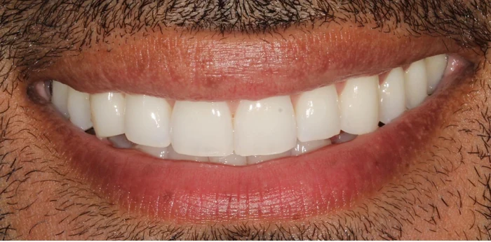 Before smile makeover with composite bonding treatment at Hacton Dental Care, Hornchurch