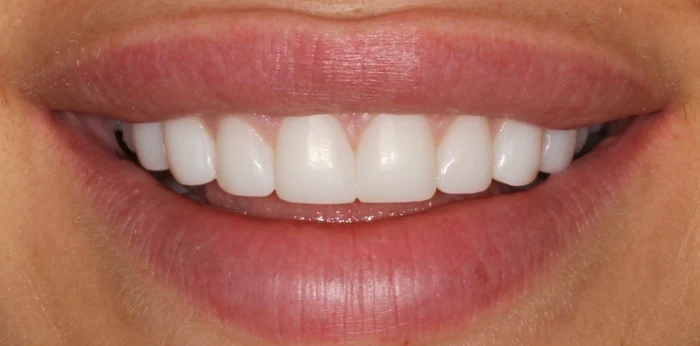 After invisalign, whitening and composite bonding treatment at Hacton Dental Care, Hornchurch