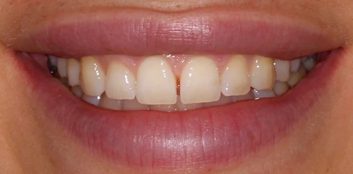 Before invisalign, whitening and composite bonding treatment at Hacton Dental Care, Hornchurch