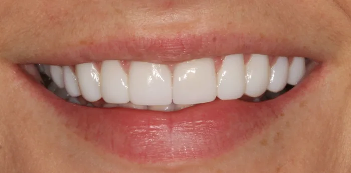 After porcelain veneers treatment at Hacton Dental Care, Hornchurch