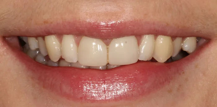 Before porcelain veneers treatment at Hacton Dental Care, Hornchurch