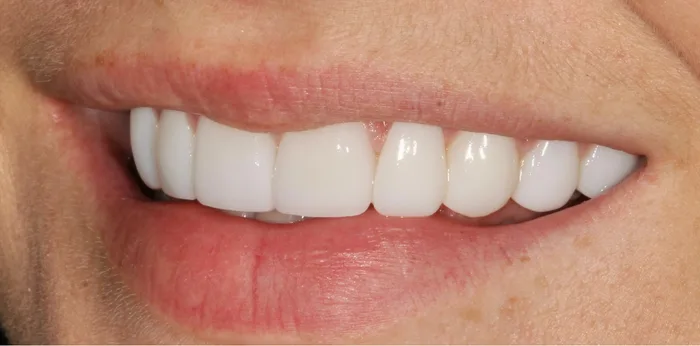 After porcelain veneers treatment at Hacton Dental Care, Hornchurch