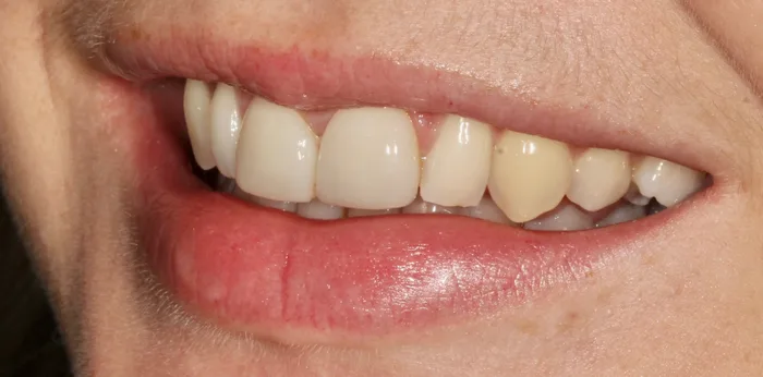 Before porcelain veneers treatment at Hacton Dental Care, Hornchurch