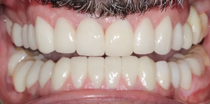 After porcelain veneers treatment at Hacton Dental Care, Hornchurch