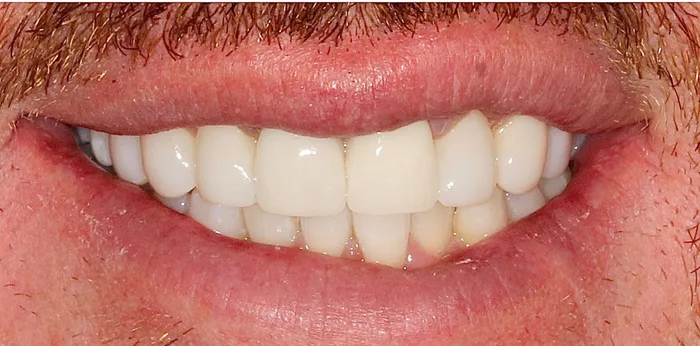 After porcelain veneers treatment at Hacton Dental Care, Hornchurch