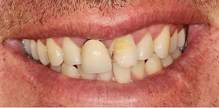 Before porcelain veneers treatment at Hacton Dental Care, Hornchurch