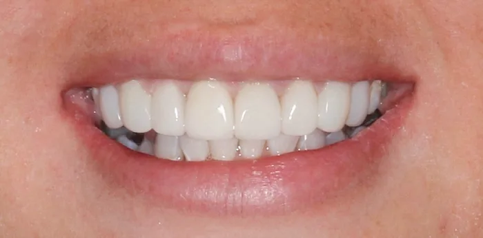 After porcelain veneers treatment at Hacton Dental Care, Hornchurch