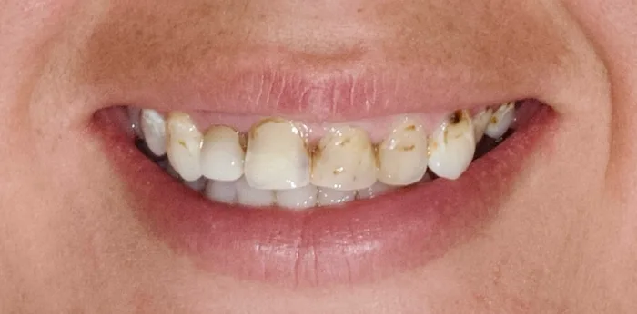 Before porcelain veneers treatment at Hacton Dental Care, Hornchurch