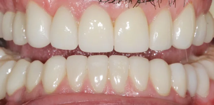 After porcelain veneers treatment at Hacton Dental Care, Hornchurch