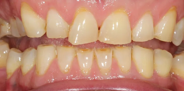 Before porcelain veneers treatment at Hacton Dental Care, Hornchurch