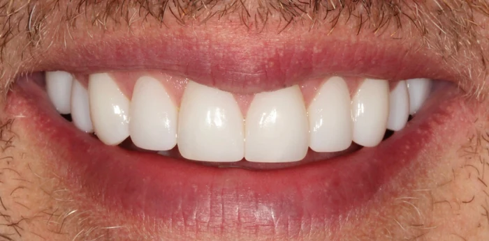 After smile makeover treatment at Hacton Dental Care, Hornchurch