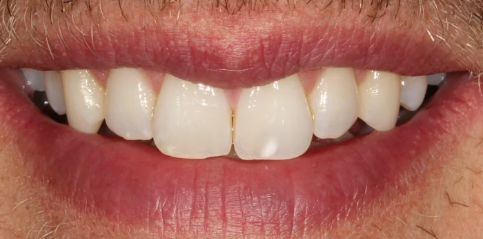Before smile makeover treatment at Hacton Dental Care, Hornchurch