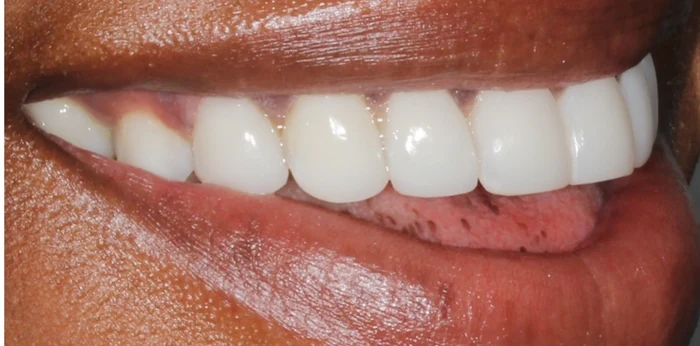 After smile makeover treatment at Hacton Dental Care, Hornchurch