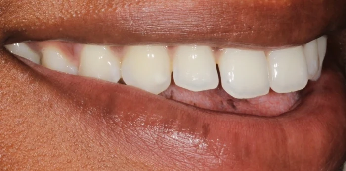 Before smile makeover treatment at Hacton Dental Care, Hornchurch