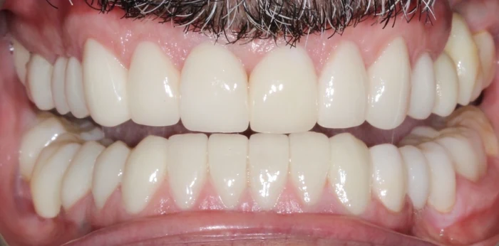 After smile makeover treatment at Hacton Dental Care, Hornchurch