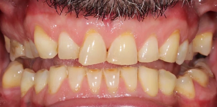 Before smile makeover treatment at Hacton Dental Care, Hornchurch