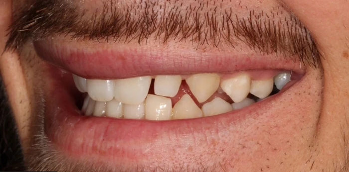 Before smile makeover treatment at Hacton Dental Care, Hornchurch