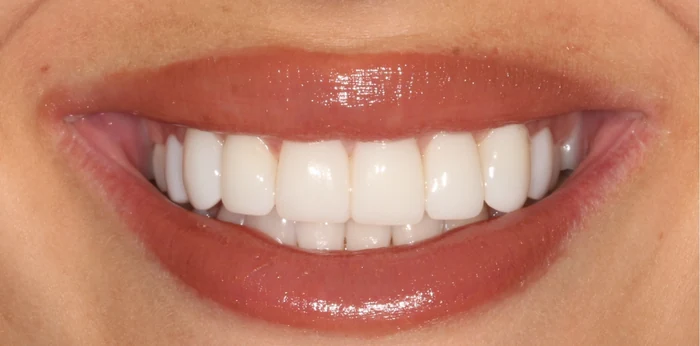 After smile makeover treatment at Hacton Dental Care, Hornchurch