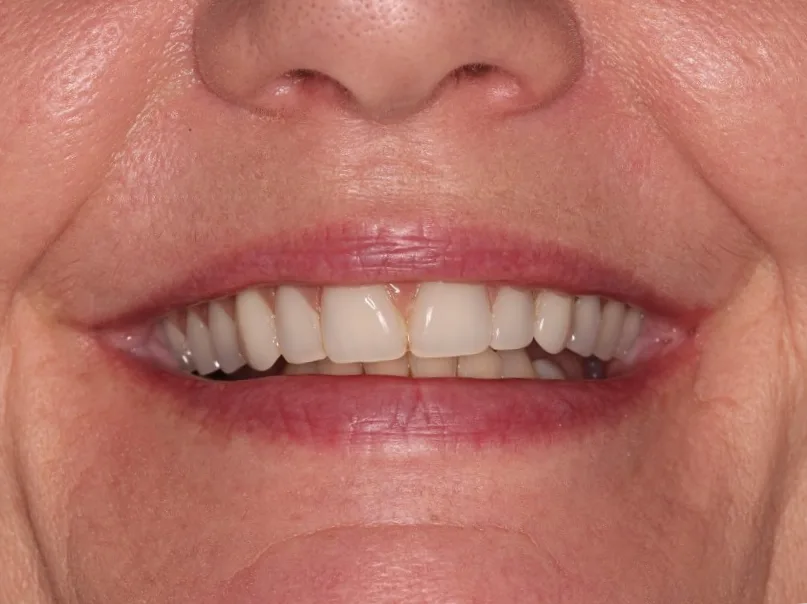 After teeth in a day with implants treatment at Hacton Dental Care, Hornchurch