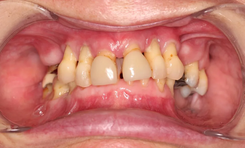 Before teeth in a day with implants treatment at Hacton Dental Care, Hornchurch