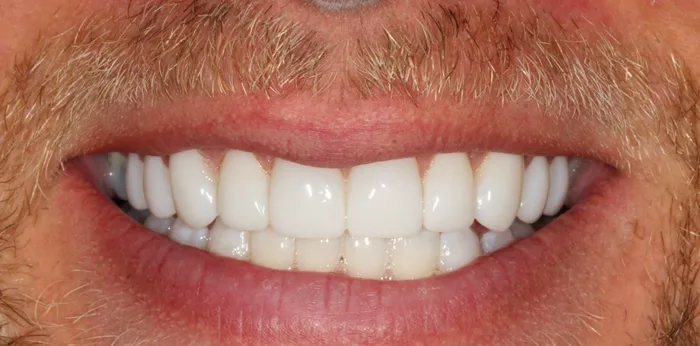 After teeth whitening treatment at Hacton Dental Care, Hornchurch
