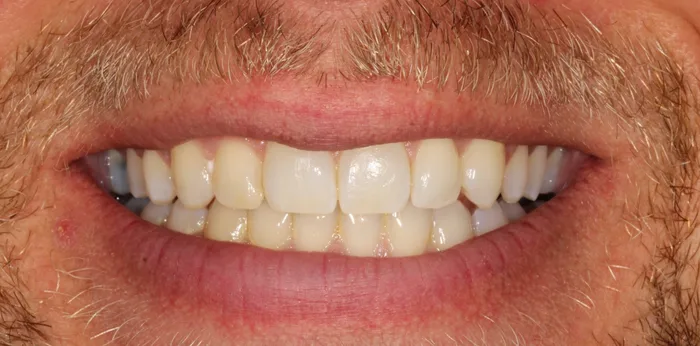 Before teeth whitening treatment at Hacton Dental Care, Hornchurch