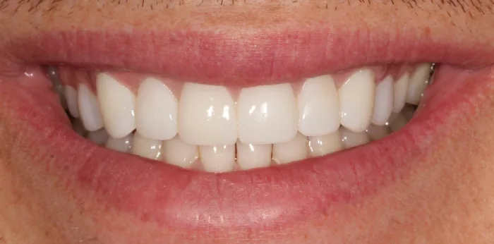 After teeth whitening treatment at Hacton Dental Care, Hornchurch