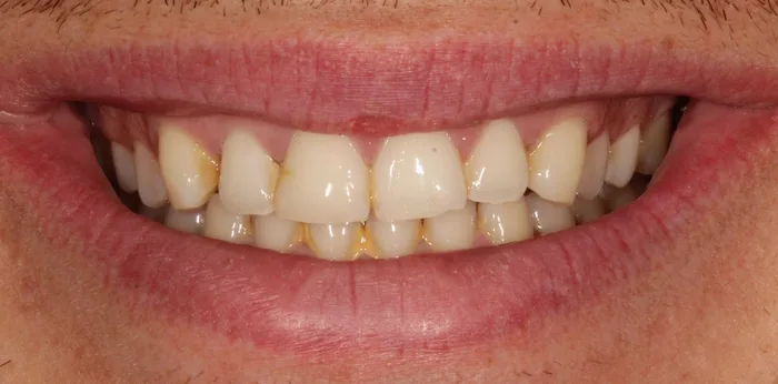 Before teeth whitening treatment at Hacton Dental Care, Hornchurch